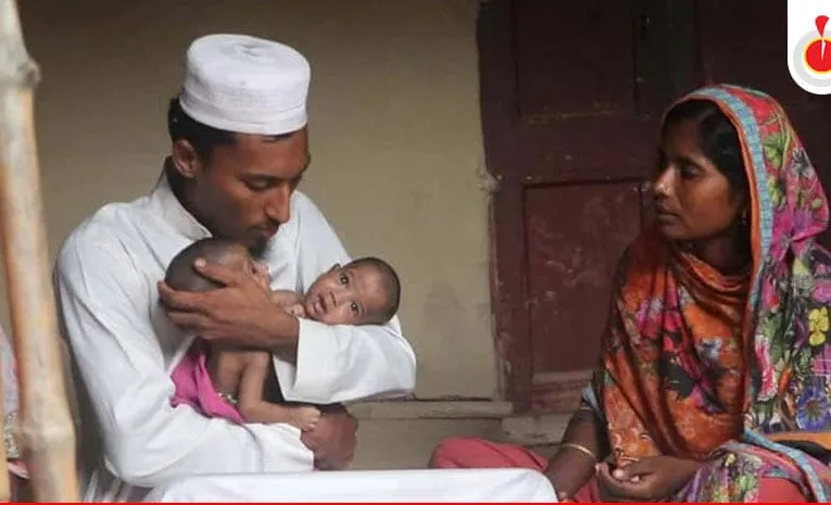 কুষ্টিয়ায় জোড়া লাগা দুই শিশুর চিকিৎসার দায়িত্ব নিলো সরকার